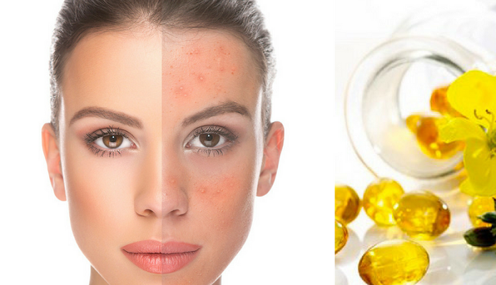 Evening Primrose Oil For Skin And Face